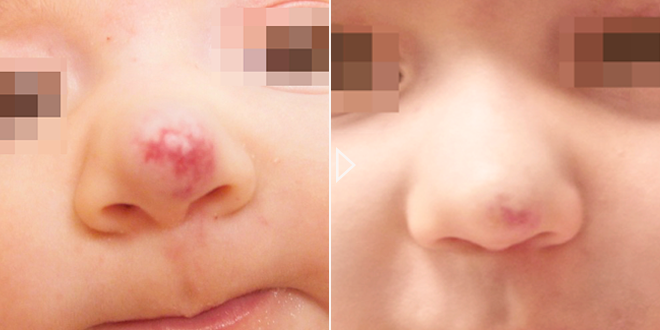 Pediatric Vascular Lesions Treatment