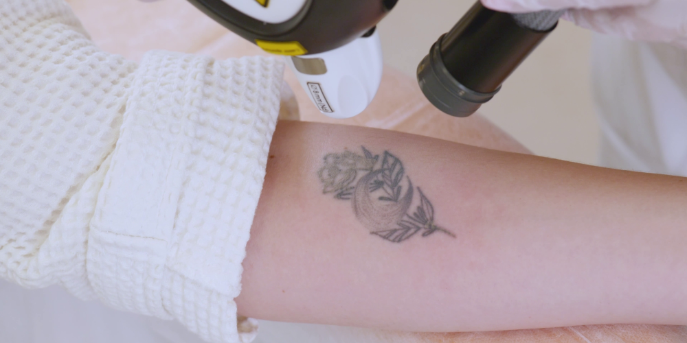 Deep Acoustic Wave™ Tattoo Removal by LINLINE