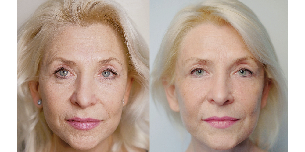 Er:YAG 2940 nm + SMA Module (RecoSMA®) — Ablation & Regenerative Emitter