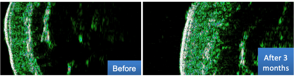 Ultrasound image DUB Cutis, 22 MHz